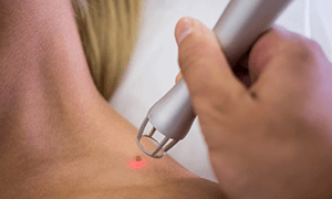 Mole Removal