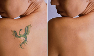 Tattoo Removal