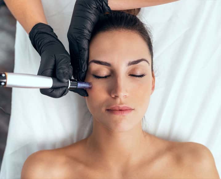 MNRF- Microneedling radio frequency