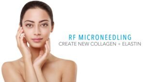 Microneedling treatment for Acne scars